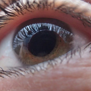 cataract