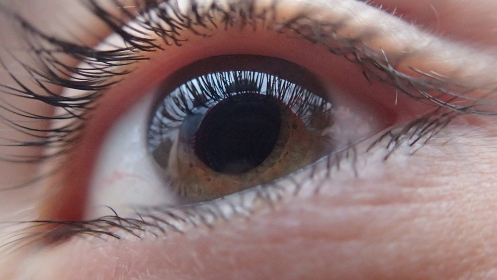 cataract