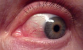 conjunctivitis