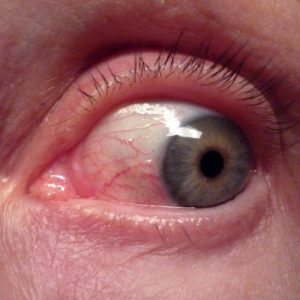 conjunctivitis