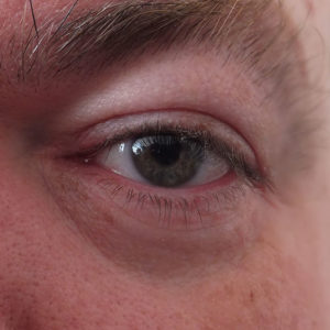 irritated eyes